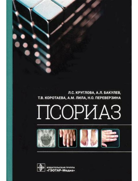 Псориаз