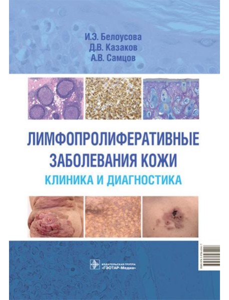 Лимфопролиферативные заболевания кожи. Клиника и диагностика