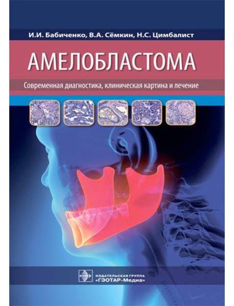 Амелобластома: современная диагностика, клиническая картина и лечение