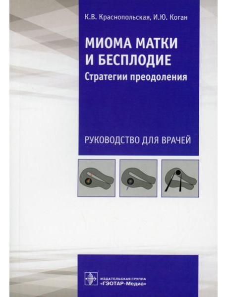 Миома матки и бесплодие: стратегии преодоления: руководство для врачей