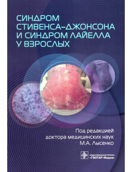 Синдром Стивенса–Джонсона и синдром Лайелла у взрослых