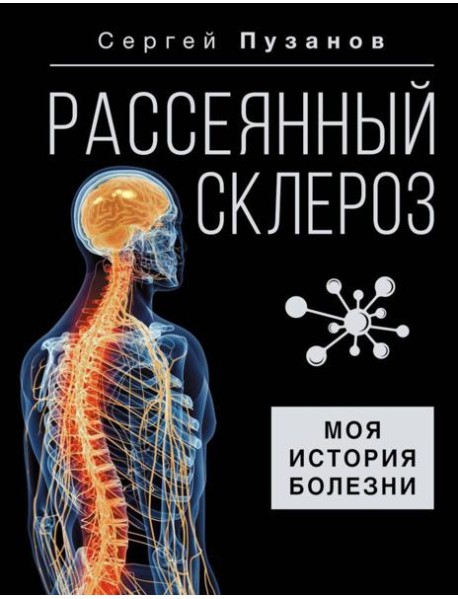 Рассеянный склероз. Моя история болезни