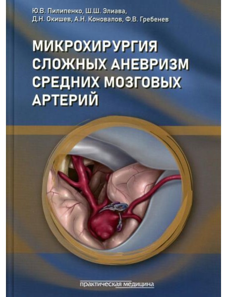 Микрохирургия сложных аневризм средних мозговых артерий: гигантских, фузиформных и частично тромбированных