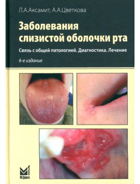 Заболевания слизистой оболочки рта. Связь с общей патологией. Диагностика. Лечение