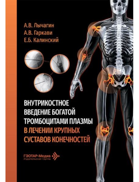 Внутрикостное введение богатой тромбоцитами плазмы в лечении крупных суставов конечностей