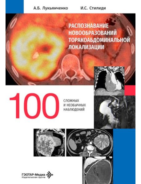 Распознавание новообразований торакоабдоминальной локализации: 100 сложных и необычных наблюдений